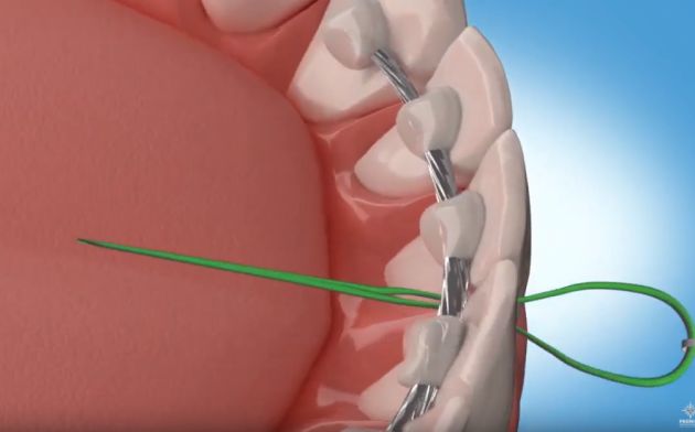 How to floss with a permanent retainer?