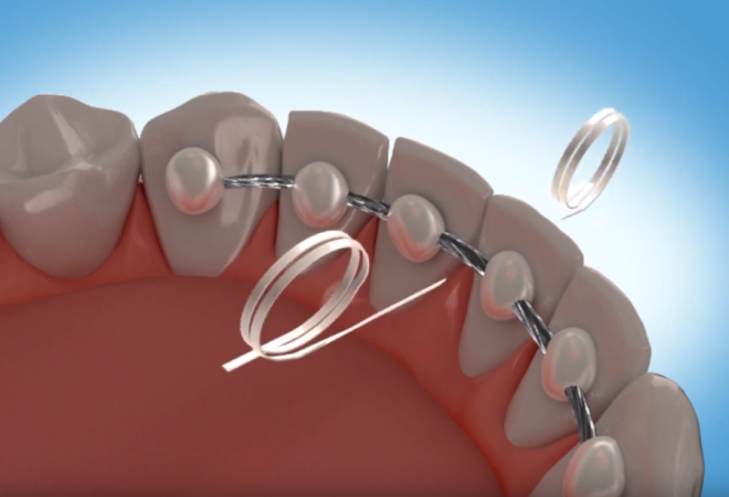 How to Floss with a Permanent Retainer